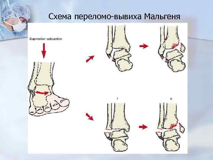 Схема переломо-вывиха Мальгеня 