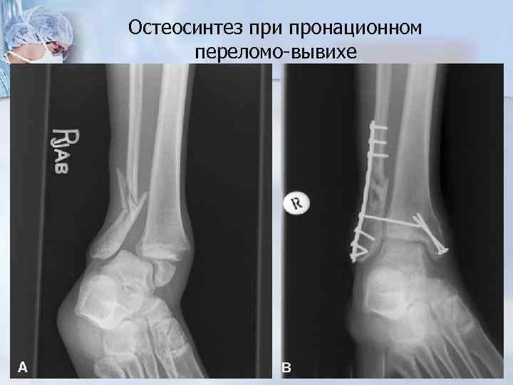 Остеосинтез при пронационном переломо-вывихе 