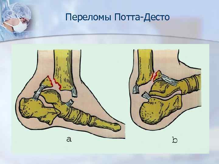 Переломы Потта-Десто 