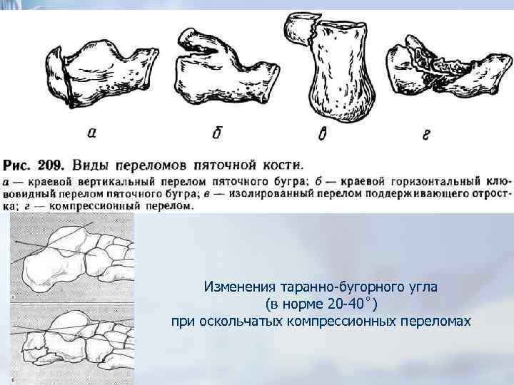 Перелом пяточной кости карта вызова