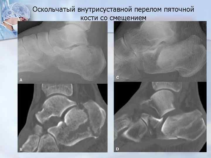 Оскольчатый перелом. Оскольчатый перелом пяточной кости. Внутрисуставной перелом пяточной кости со смещением. Закрытый оскольчатый перелом тела правой пяточной кости со смещением. Пяточная кость осколочный перелом.