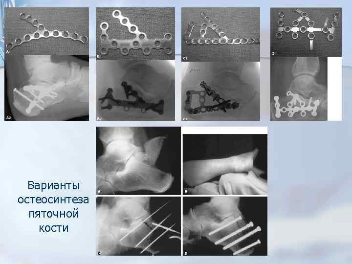 Варианты остеосинтеза пяточной кости 