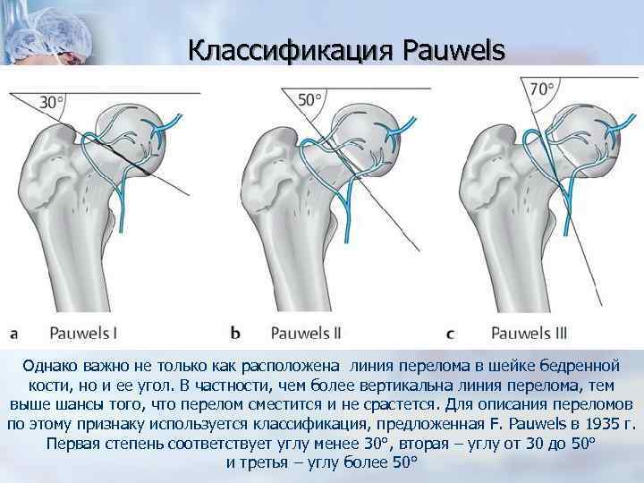 Карта вызова смп перелом шейки бедра справа