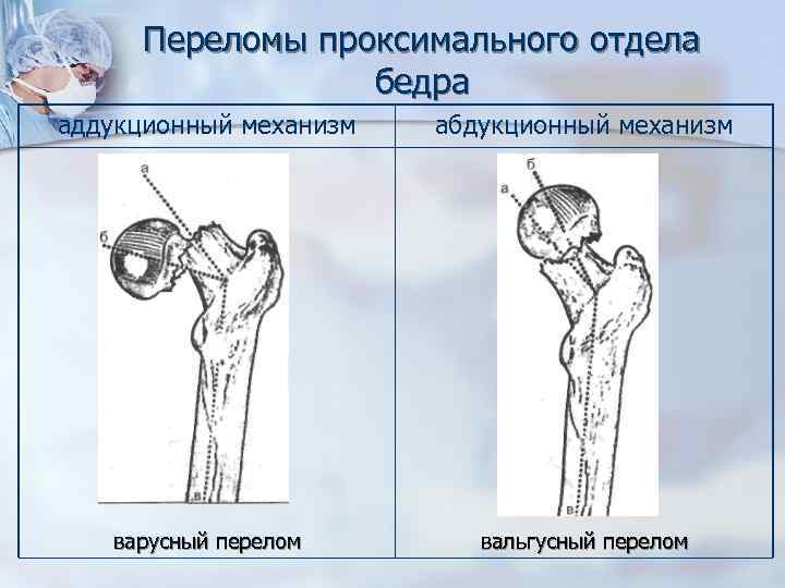 Переломы проксимального отдела бедренной кости тесты нмо