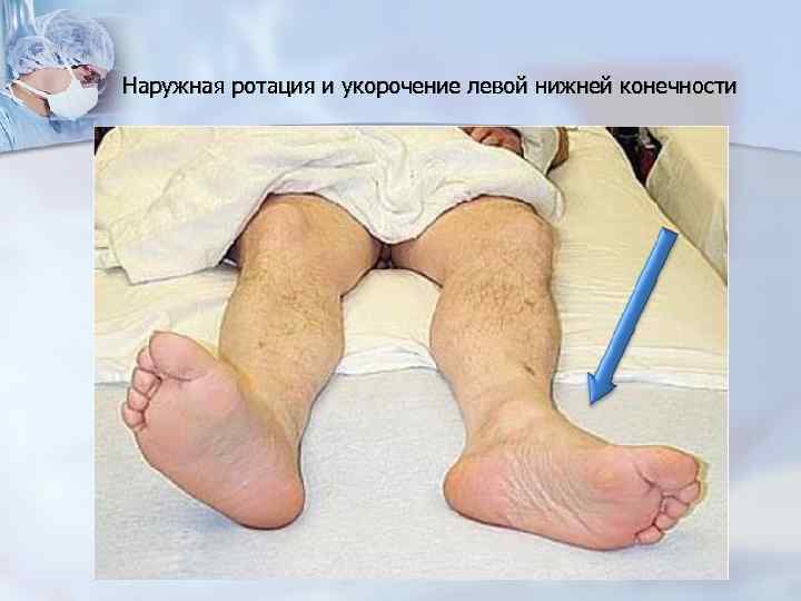 Наружная ротация и укорочение левой нижней конечности 