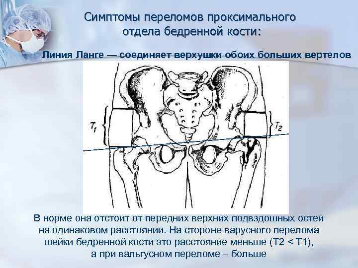 Переломы проксимального отдела бедренной кости тесты нмо