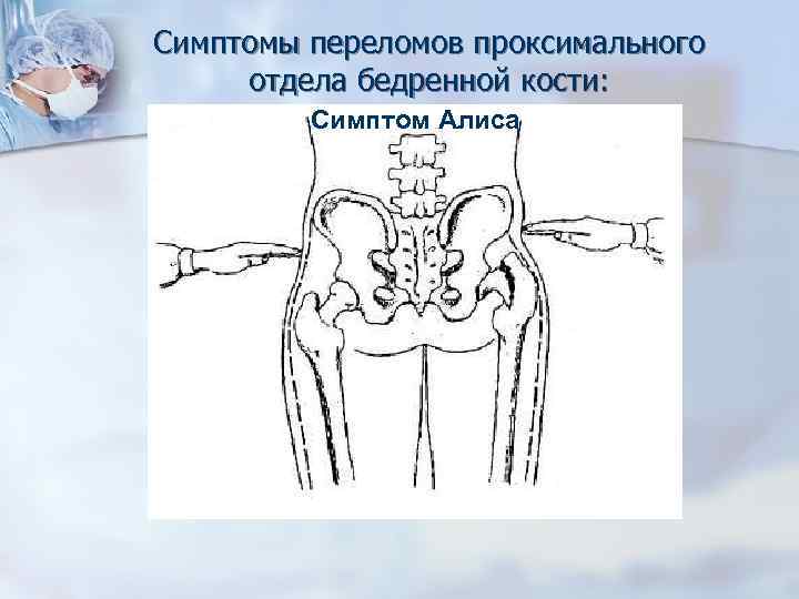 Переломы проксимального отдела бедренной кости презентация