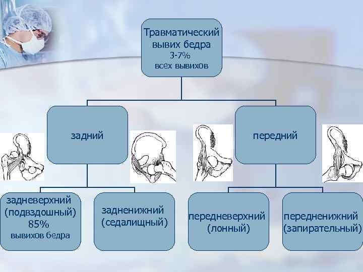 Травматический вывих бедра 3 -7% всех вывихов задний задневерхний (подвздошный) 85% вывихов бедра задненижний