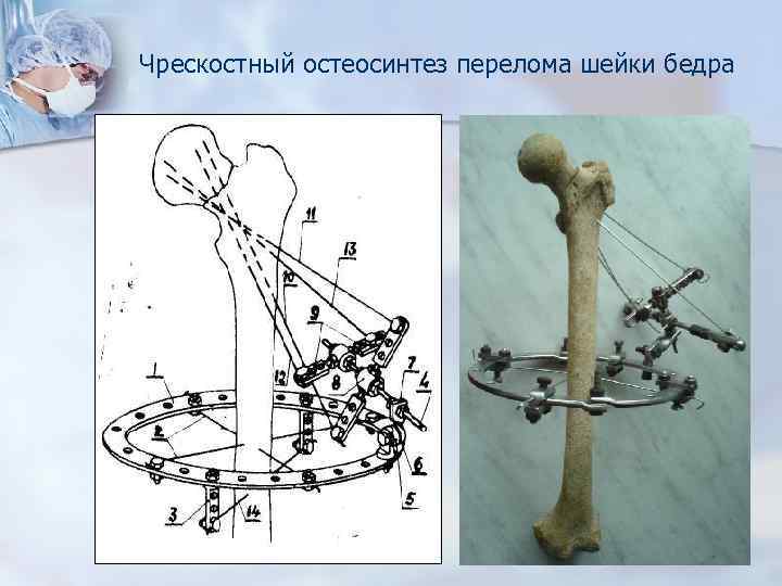 Чрескостный остеосинтез перелома шейки бедра 