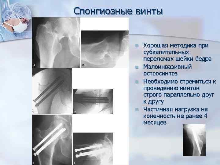 Спонгиозные винты n n Хорошая методика при субкапитальных переломах шейки бедра Малоинвазивный остеосинтез Необходимо