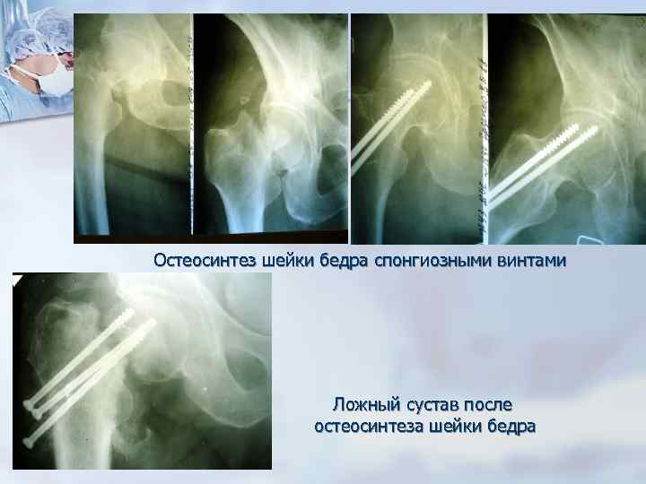 Остеосинтез шейки бедра спонгиозными винтами Ложный сустав после остеосинтеза шейки бедра 