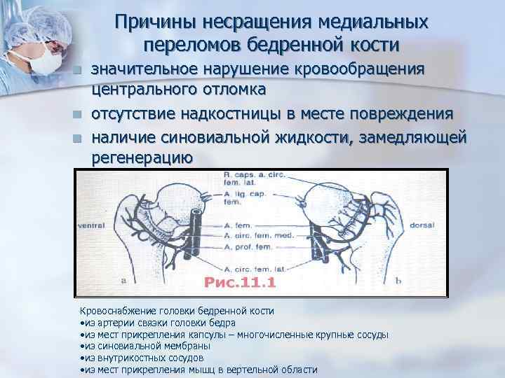 субкапитальный перелом шейки бедренной кости