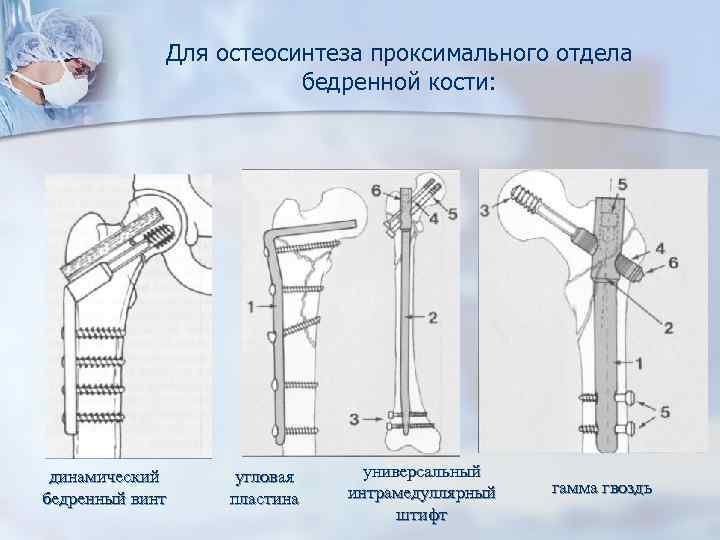 Для остеосинтеза проксимального отдела бедренной кости: динамический бедренный винт угловая пластина универсальный интрамедуллярный штифт