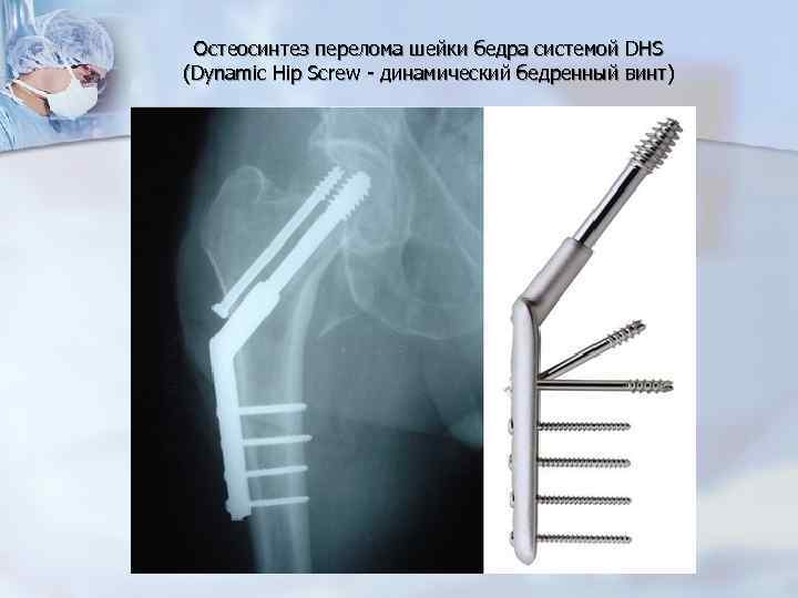 Остеосинтез перелома шейки бедра системой DHS (Dynamic Hip Screw - динамический бедренный винт) 