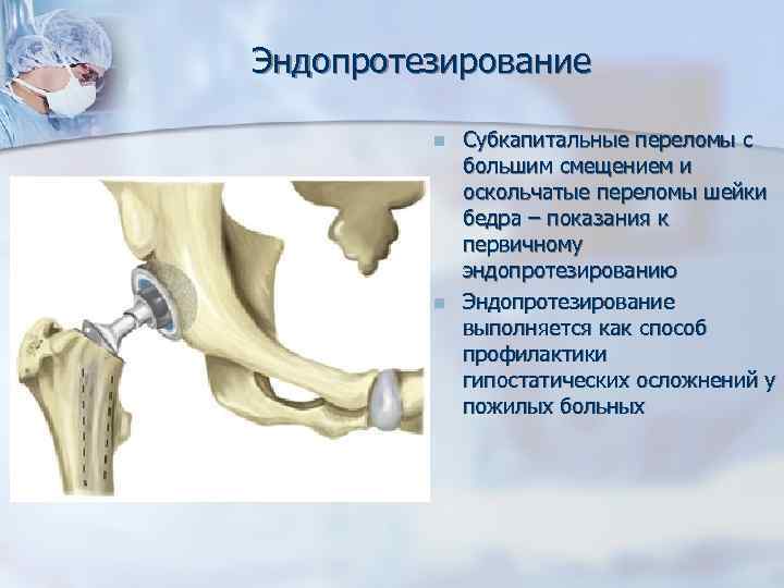 Перелом шейки бедра лечение операции. Субкапитальный перелом шейки бедра. Субкапитальный перелом шейки бедренной. Перелом бедренной кости в тазобедренном суставе. Аддукционные переломы шейки бедра.