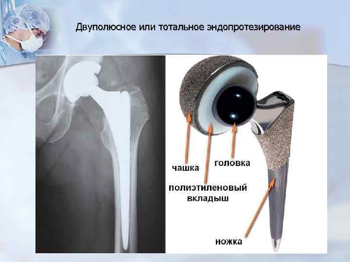 Двуполюсное или тотальное эндопротезирование 