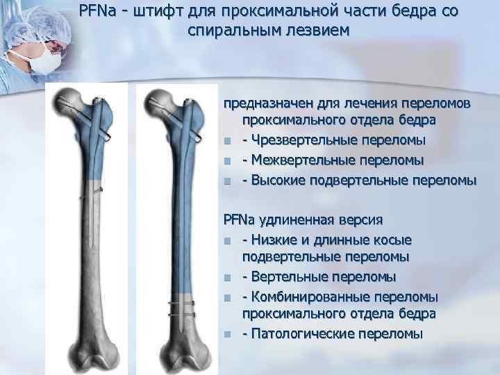 Проксимальный бедренный штифт Stryker. Гамма гвоздь проксимальный бедренный. Гамма штифт PFNA. Переломы проксимального отдела бедра.