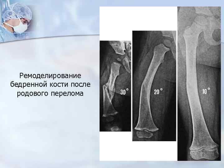 Ремоделирование бедренной кости после родового перелома 