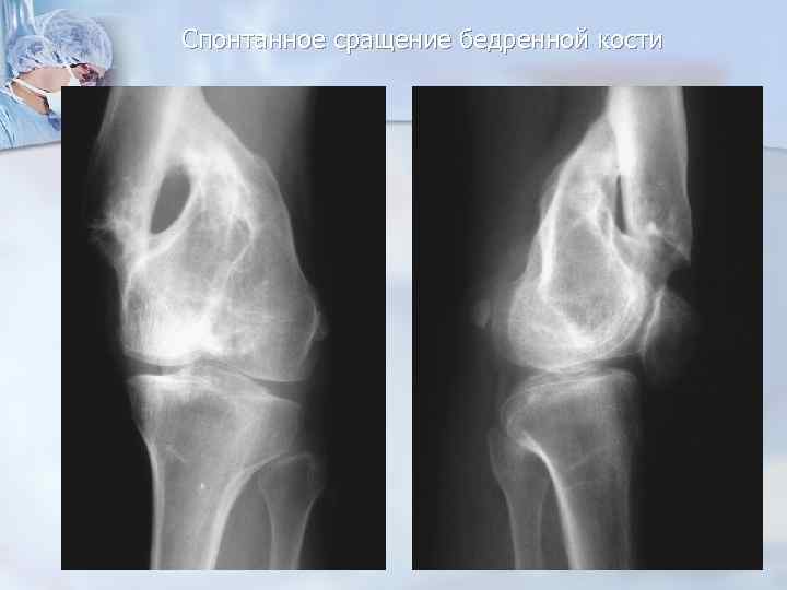 Спонтанное сращение бедренной кости 