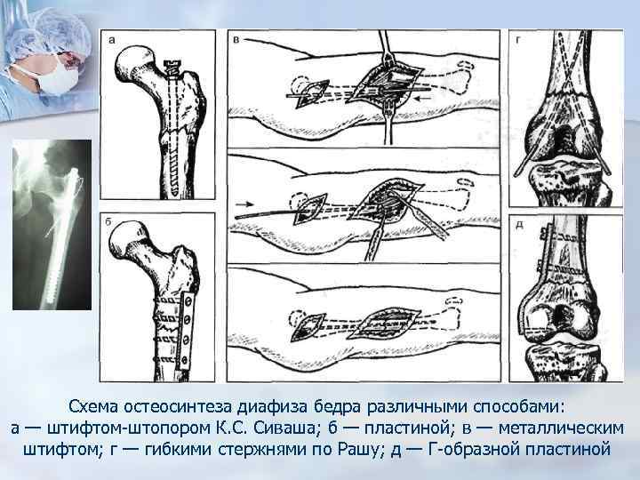 Схема остеосинтеза диафиза бедра различными способами: а — штифтом-штопором К. С. Сиваша; б —