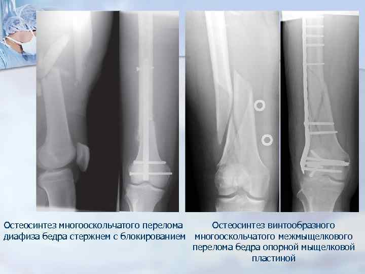 При дтп неизвестный молодой человек получил открытый многооскольчатый перелом нижней трети