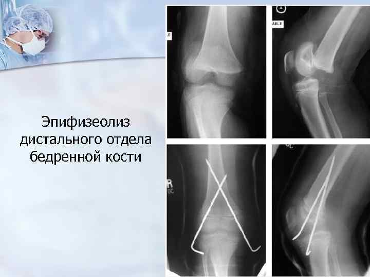 Дистальные переломы бедренной кости. Переломы дистального отдела плечевой кости. Эпифизеолиз (перелом Салтера-Харриса);. Дистальный эпифизеолиз. Эпифизеолиз локтевого отростка.