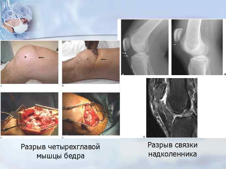 Разрыв четырехглавой мышцы бедра Разрыв связки надколенника 