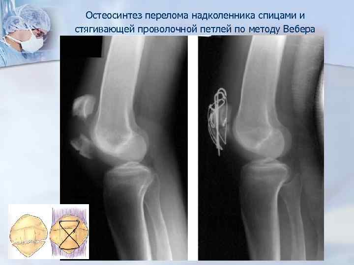 Перелом надколенника операция. Металлоостеосинтез коленного сустава. Перелом надколенника и остеосинтез по Веберу. Перелом надколенника по Веберу. Перелом надколенника остеосинтез.