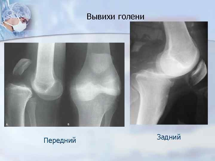 Вывих колена. Подвывих коленного сустава рентген. Вывих костей голени классификация. Вывих голени в коленном суставе рентген. Травматический вывих коленного сустава.