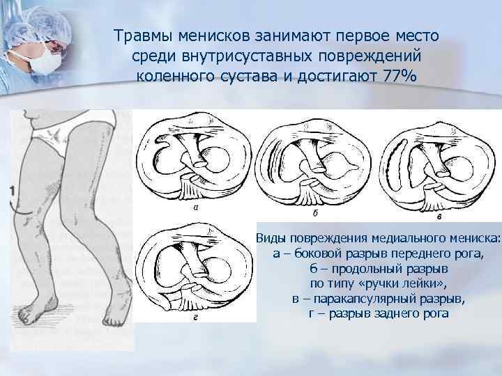 Травмы менисков занимают первое место среди внутрисуставных повреждений коленного сустава и достигают 77% Виды