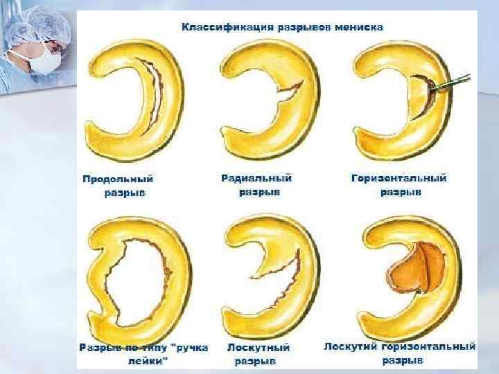 Типы повреждения мениска. Повреждение менисков коленного сустава классификация. Косо горизонтальный разрыв медиального мениска 3 степени. Косой разрыв заднего рога медиального мениска коленного сустава. Горизонтальный разрыв тела латерального мениска.