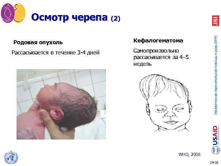 Родовая опухоль Кефалогематома Рассасывается в течение 3 -4 дней Самопроизвольно рассасывается за 4– 5