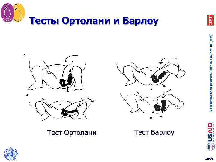 Эффективная перинатальная помощь и уход (ЭПУ) Тесты Ортолани и Барлоу Тест Ортолани Тест Барлоу