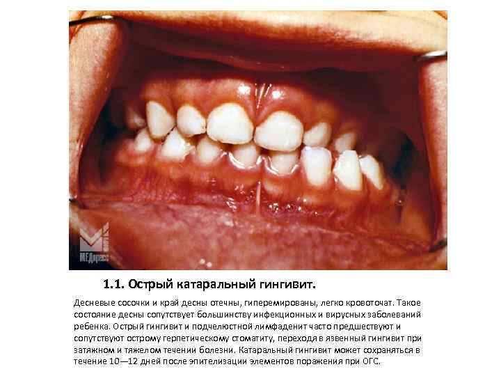 1. 1. Острый катаральный гингивит. Десневые сосочки и край десны отечны, гиперемированы, легко кровоточат.