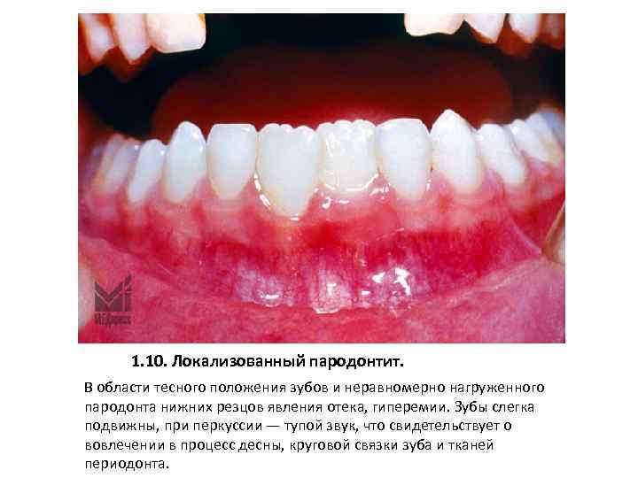1. 10. Локализованный пародонтит. В области тесного положения зубов и неравномерно нагруженного пародонта нижних