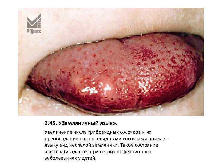 2. 45. «Земляничный язык» . Увеличение числа грибовидных сосочков и их преобладание нал нитевидными