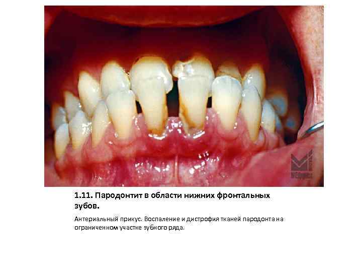 1. 11. Пародонтит в области нижних фронтальных зубов. Антериальный прикус. Воспаление и дистрофия тканей
