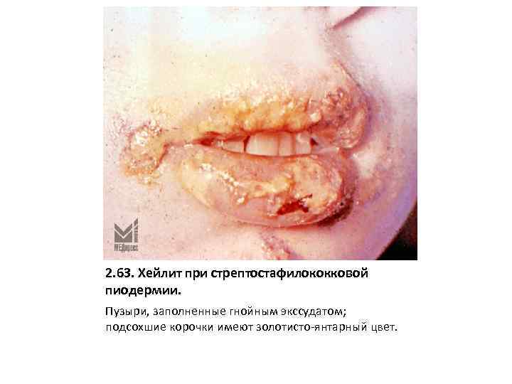 2. 63. Хейлит при стрептостафилококковой пиодермии. Пузыри, заполненные гнойным экссудатом; подсохшие корочки имеют золотисто-янтарный
