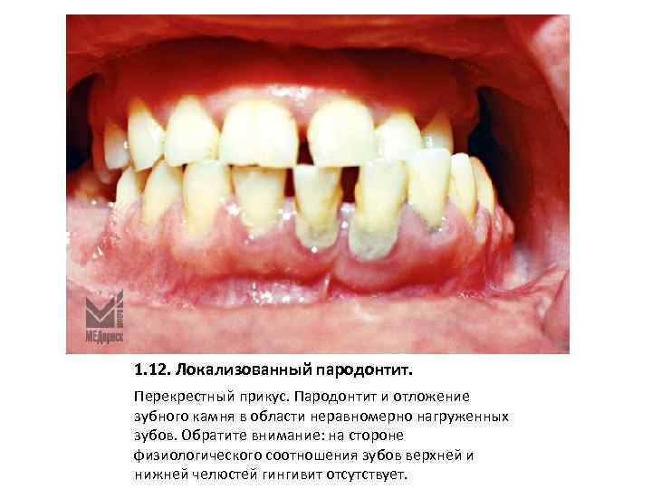 1. 12. Локализованный пародонтит. Перекрестный прикус. Пародонтит и отложение зубного камня в области неравномерно