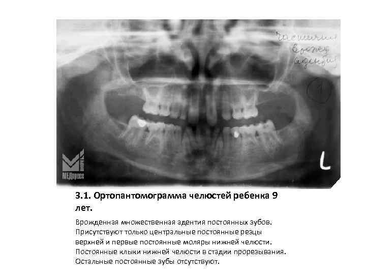 3. 1. Ортопантомограмма челюстей ребенка 9 лет. Врожденная множественная адентия постоянных зубов. Присутствуют только