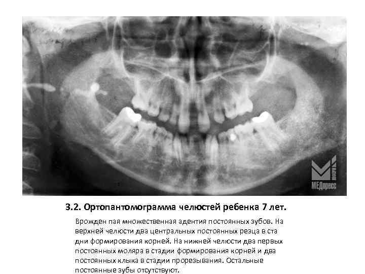 Опг зубов фото