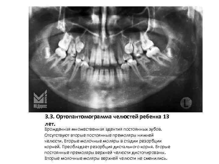 3. 3. Ортопантомограмма челюстей ребенка 13 лет. Врожденная множественная адентия постоянных зубов. Отсутствуют вторые