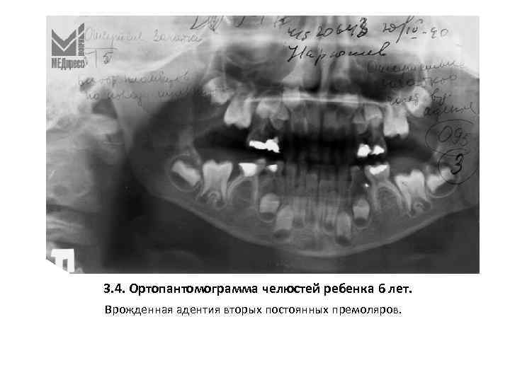 3. 4. Ортопантомограмма челюстей ребенка 6 лет. Врожденная адентия вторых постоянных премоляров. 