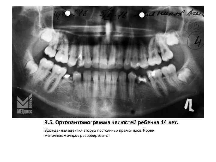 3. 5. Ортопантомограмма челюстей ребенка 14 лет. Врожденная адентия вторых постоянных премоляров. Корни молочных