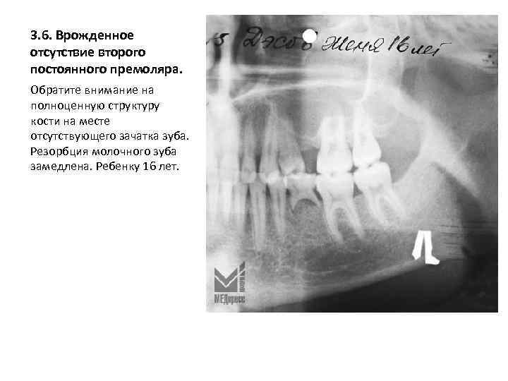 3. 6. Врожденное отсутствие второго постоянного премоляра. Обратите внимание на полноценную структуру кости на