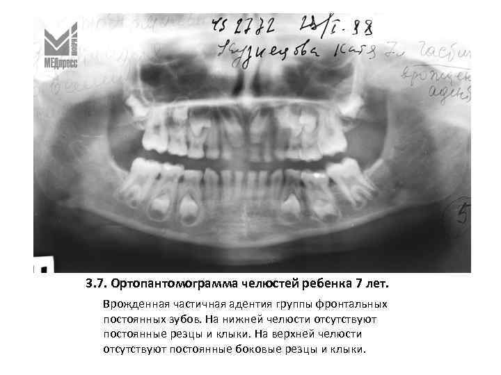 3. 7. Ортопантомограмма челюстей ребенка 7 лет. Врожденная частичная адентия группы фронтальных постоянных зубов.