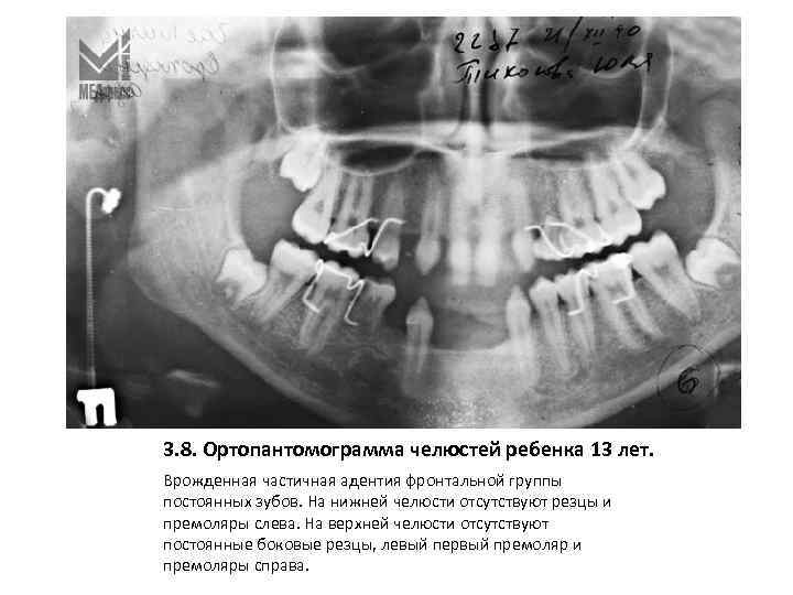 3. 8. Ортопантомограмма челюстей ребенка 13 лет. Врожденная частичная адентия фронтальной группы постоянных зубов.