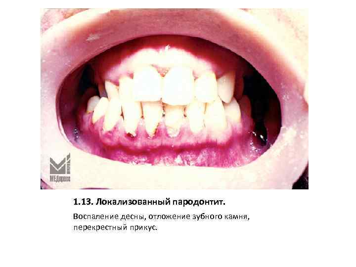 1. 13. Локализованный пародонтит. Воспаление десны, отложение зубного камня, перекрестный прикус. 