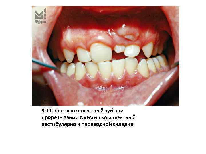 3. 11. Сверхкомплектный зуб при прорезывании сместил комплектный вестибулярно к переходной складке. 