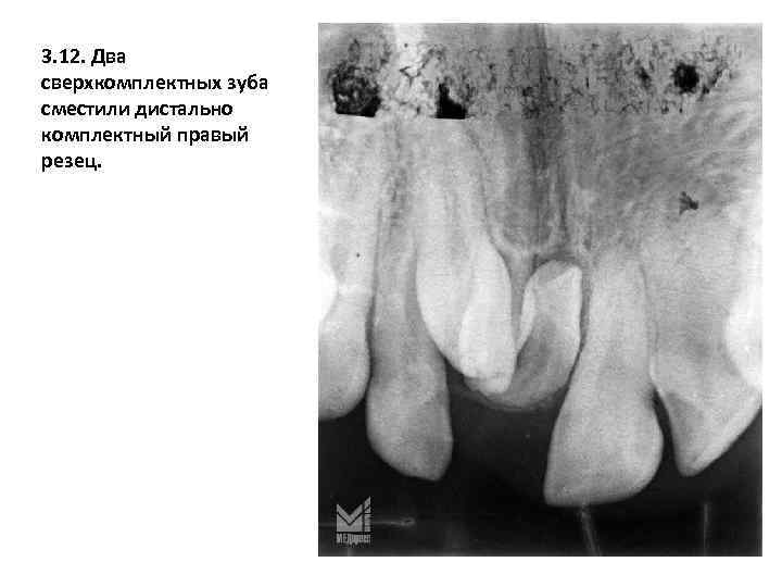 3. 12. Два сверхкомплектных зуба сместили дистально комплектный правый резец. 